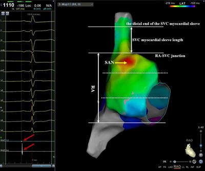 Three-dimensional electroanatomic mapping characteristics of superior vena cava myocardial sleeve and sinoatrial node in patients with atrial fibrillation